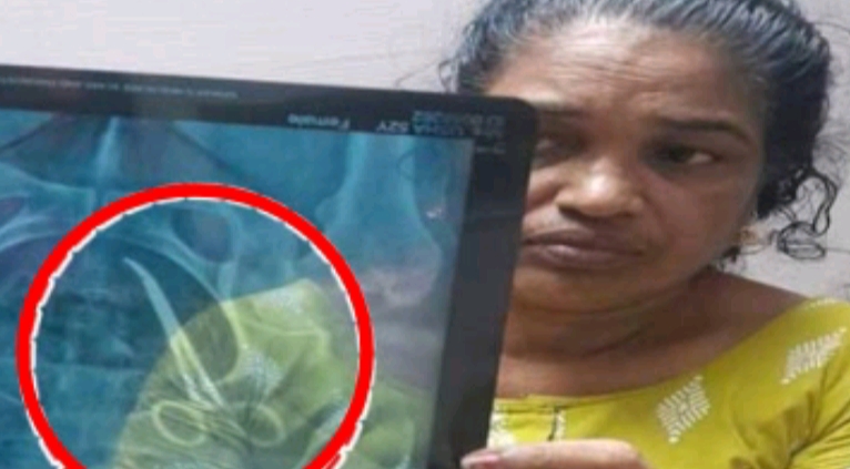 డాక్టర్ల నిర్లక్ష్యం కలకలం.. ఐదేళ్లుగా మహిళ కడుపులో కత్తెర!