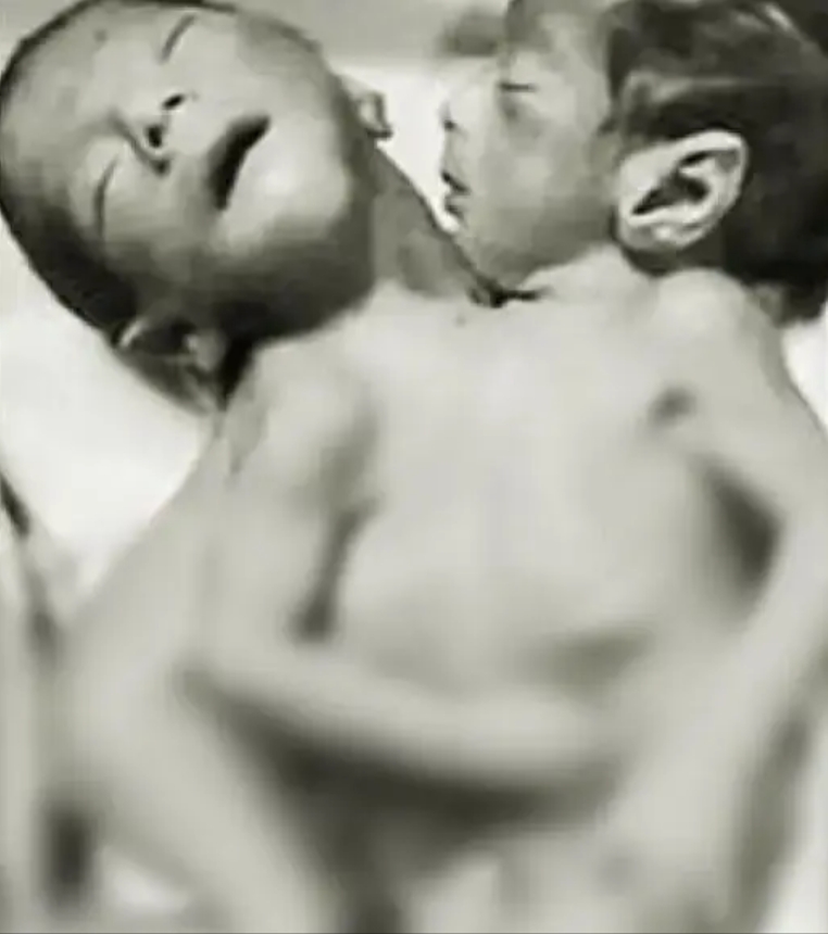 ఒకే దేహం.. రెండు తలలు, నాలుగు కాళ్లతో అవిభాజ్య కవలలు జననం!